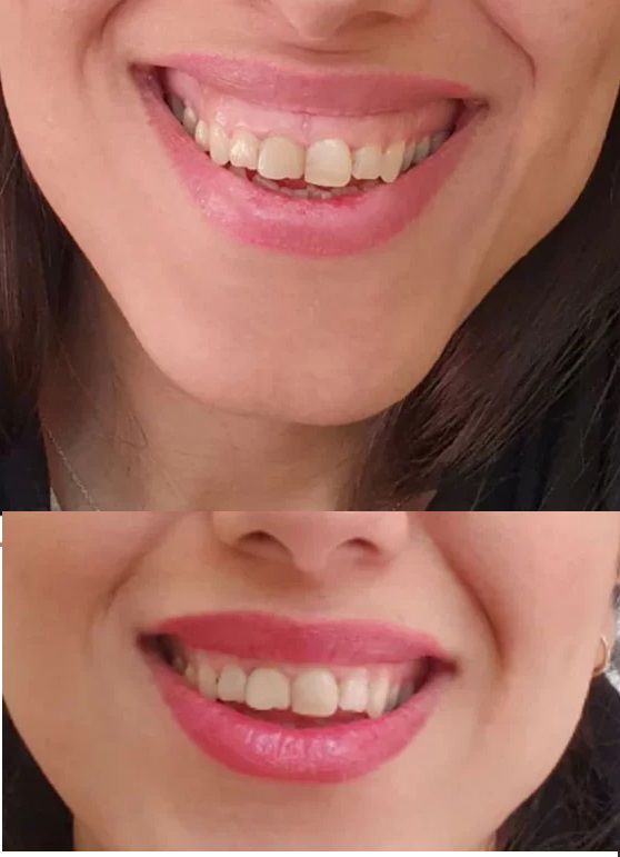 بوتاکس لبخند لثه‌ای در کلینیک زیبایی شرق تهران دکتر مهشید طالبی