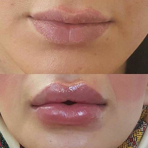 تزریق فیلر لب  810