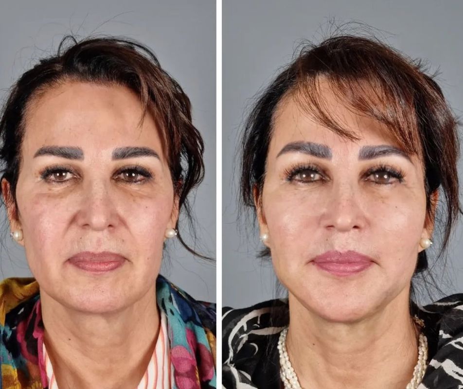 تزریق فیلر محیطی جهت لیفت صورت 820